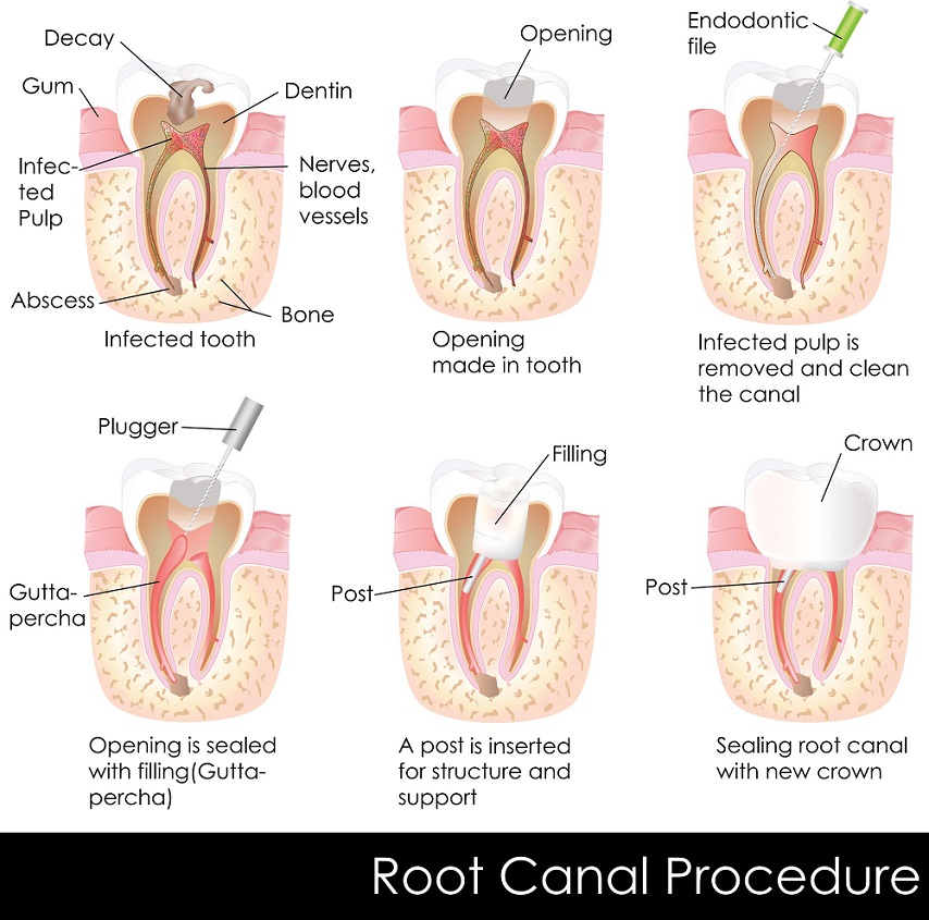 canal-treatment