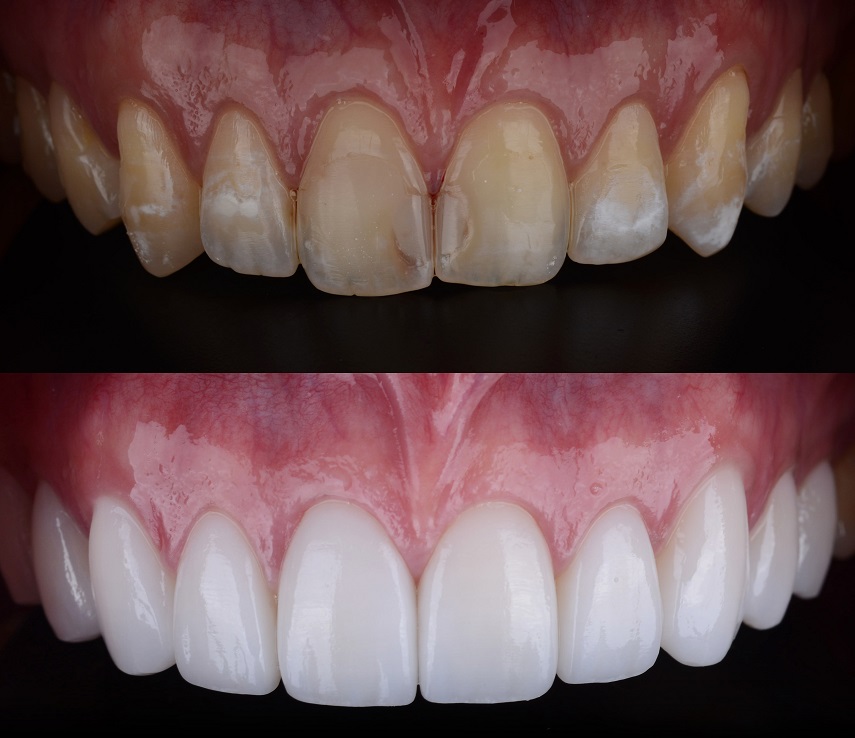 dental-veneers