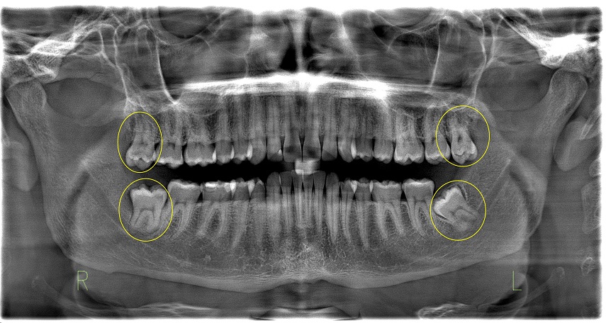 canal-treatment