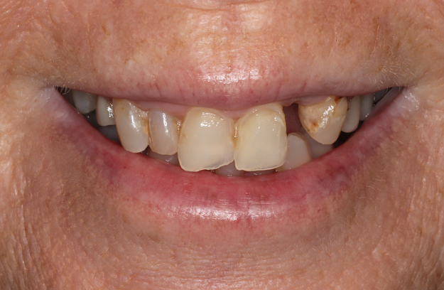 Before - Case 1
