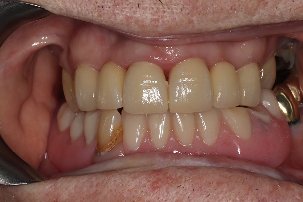After - Case 5