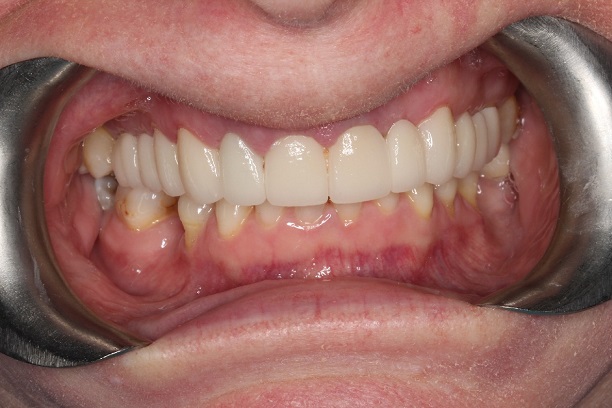 After - Case 4