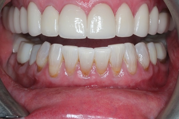 After - Case 5