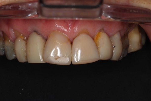 Before - Case 2