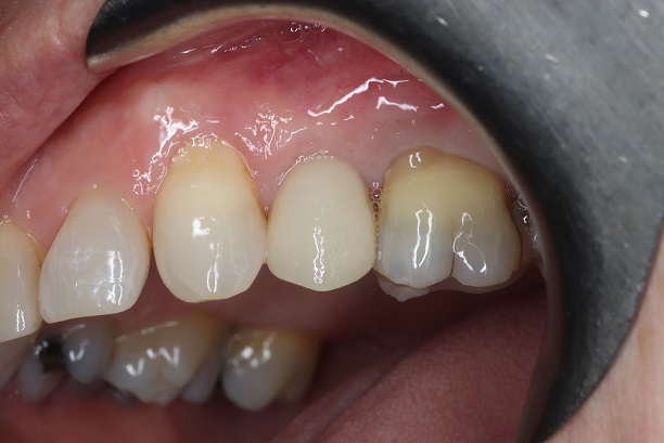 After - Case 5