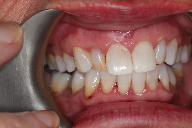 After - Case 1