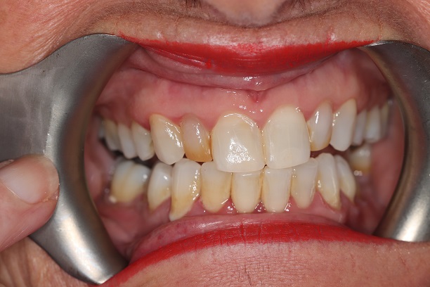 Before - Case 1